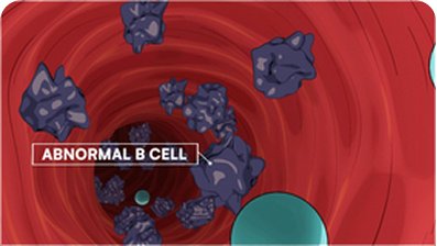 MCL Abnormal B Cell